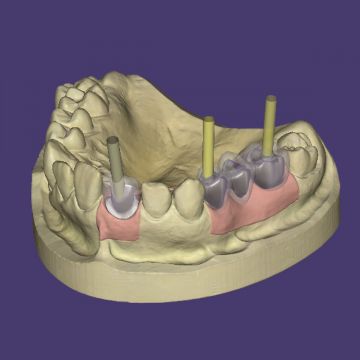 exocad® module Implant (Abutments)