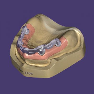 exocad® module bars