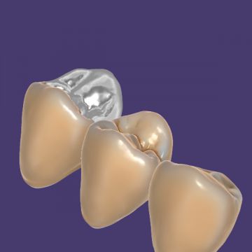 exocad® module TruSmile