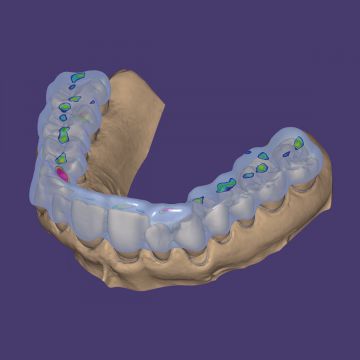 exocad® module bite splint