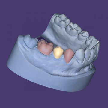exocad® module Provisionals