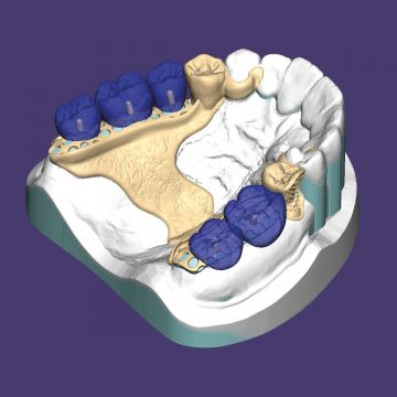 exocad® module PartialCAD