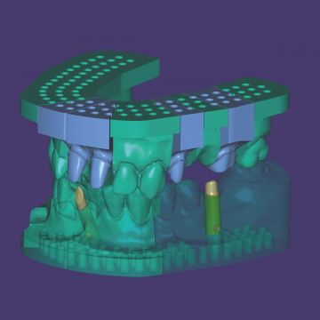 exocad® module Model Creator