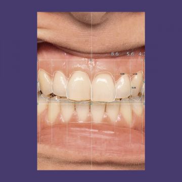 exocad® module Smile Creator