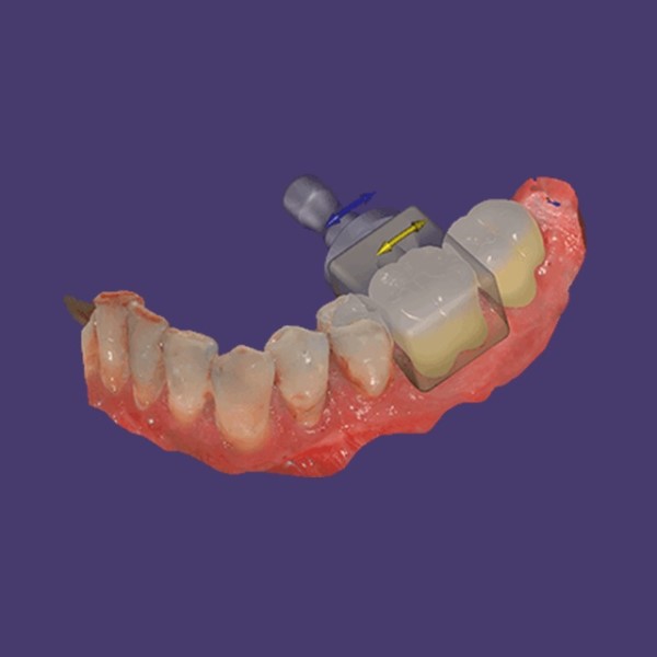 exocad® module Nesting